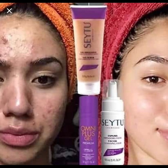 Acne cream kit - Picture 1 of 1